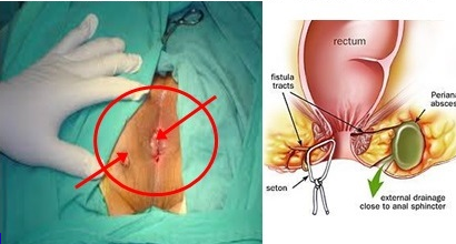 PENYAKIT FISTULA ANI